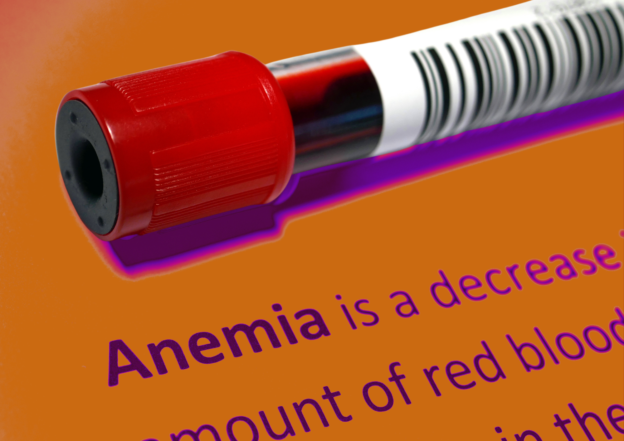 Iron deficiency anemia